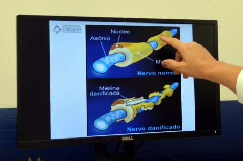 Exame rápido e barato detecta infecção causada por hanseníase