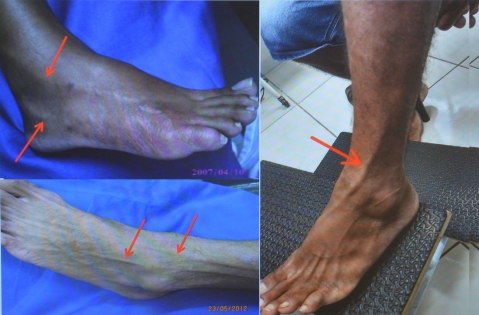 Hanseníase no pé e na perna: como as palmilhas podem ajudar