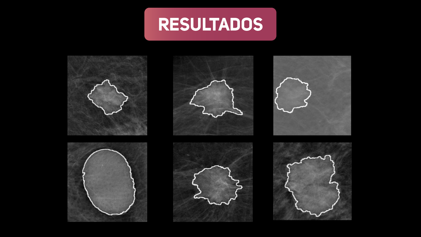 Exemplos de nódulos encontrados em imagens de mamografia diferentes através da ferramenta computacional